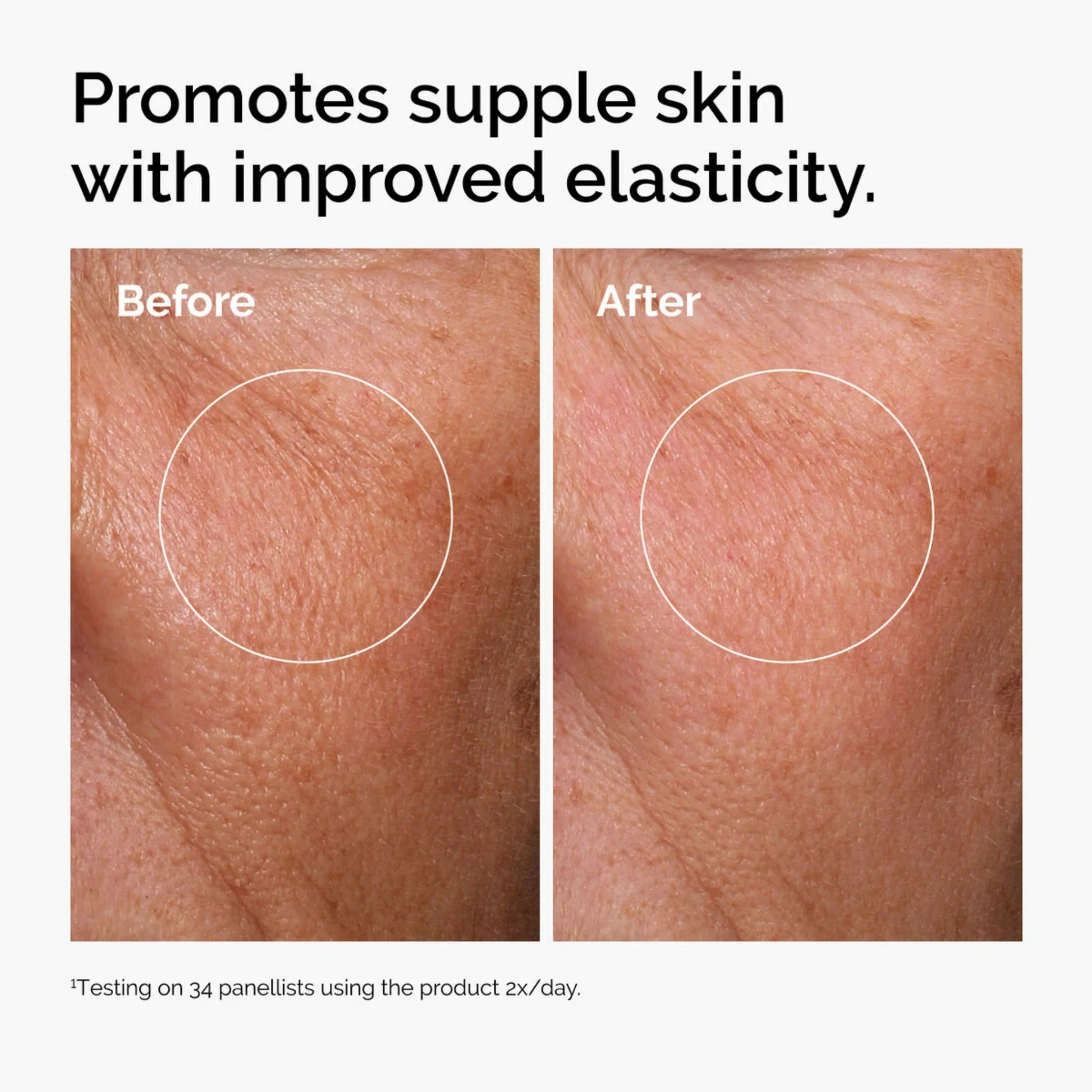 ordinary hyaluronic acid before and after